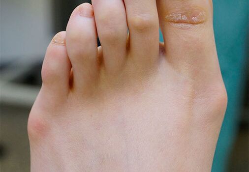 Pé de valgus
