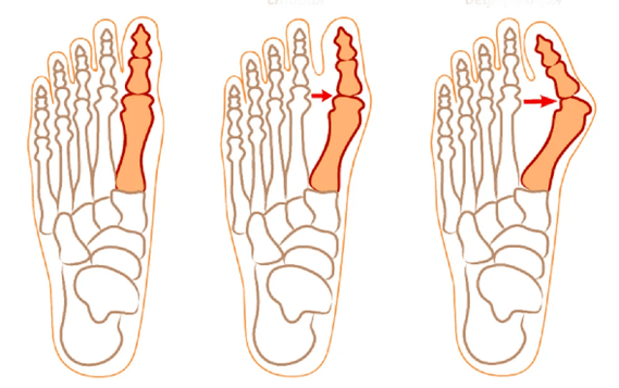 Hallux Valgus Deformidade