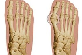 Causas do hallux valgus