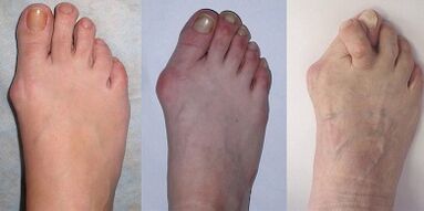 Etapas do hallux valgus