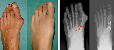 Síntomas de hallux valgus