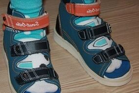 Usar sandalias para hallux valgus nun neno