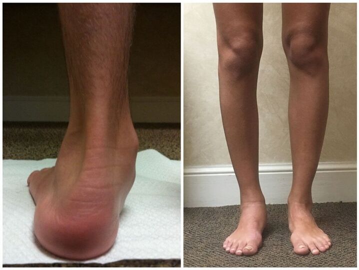 Pernas con hallux valgus