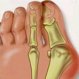 Os motivos de Valgus