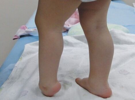 Os primeiros síntomas da deformación do valgus do pé