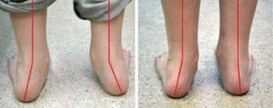 Curvatura de Valgus